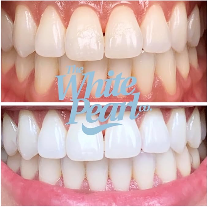 Teeth Whitening Kit with LED Light, Wireless, 35% Carbamide Peroxide, Desensitizing Agent, Enamel Safe, Gentle on Teeth