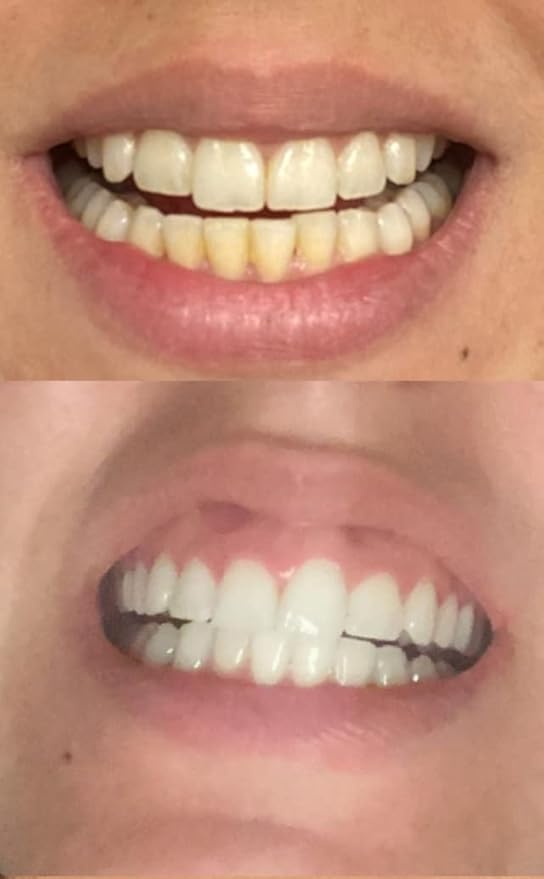 Teeth Whitening Gel Refill 4X Syringes 44% Carbamide Peroxide