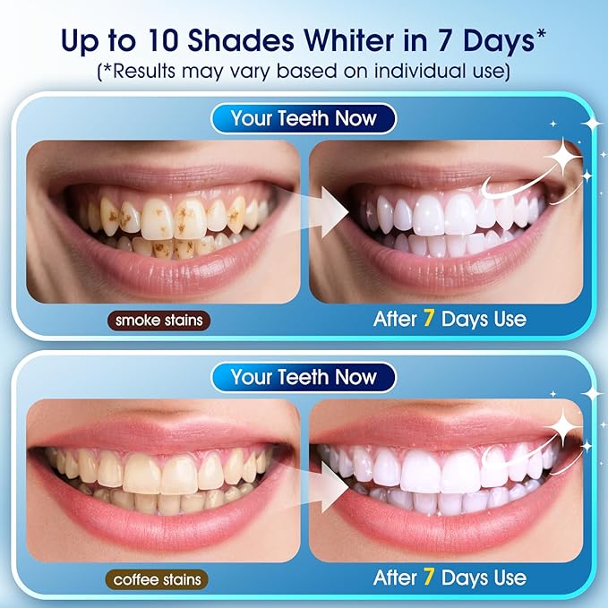 Teeth Whitening Kit – 3 Teeth Whitening Pens + 2 Desensitizing Pens – LED Light – 35% Carbamide Peroxide – Safe & Dentist-Recommended – Fast 7-Day Visible Whitening + Remineralizing Care