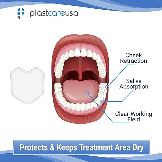 200 Dental Dry Corners, Disposable Saliva Control & Cheek Protection Pads Super Absorbent Non-Woven Padding (Cotton Roll Alternative) (Small)