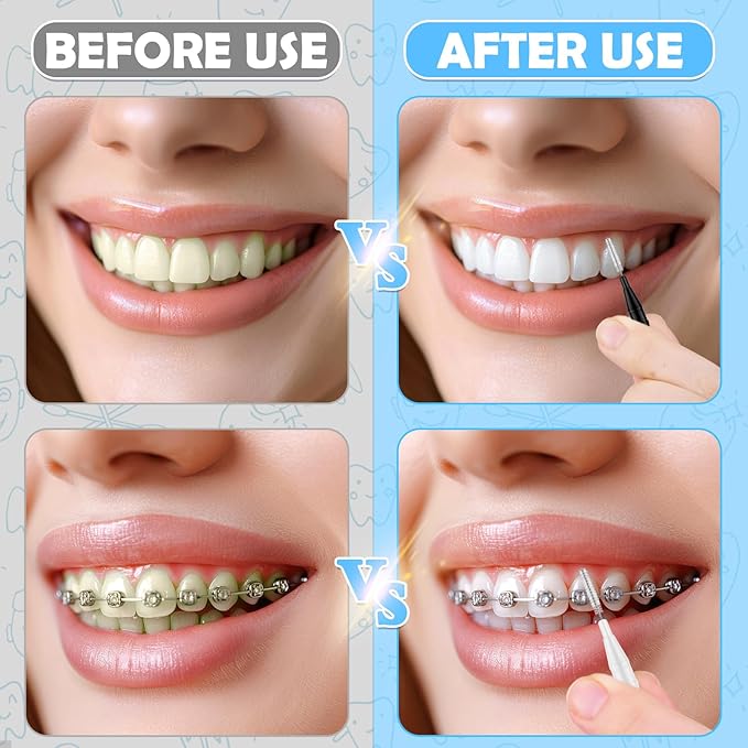 120Pcs Interdental Brushes, 360° Bendable Soft Bristles Braces Flossers Dental Brushes Between Teeth Gum Interdental Brushes for Gum Braces Oral Teeth Cleaning Tool (Black, White)