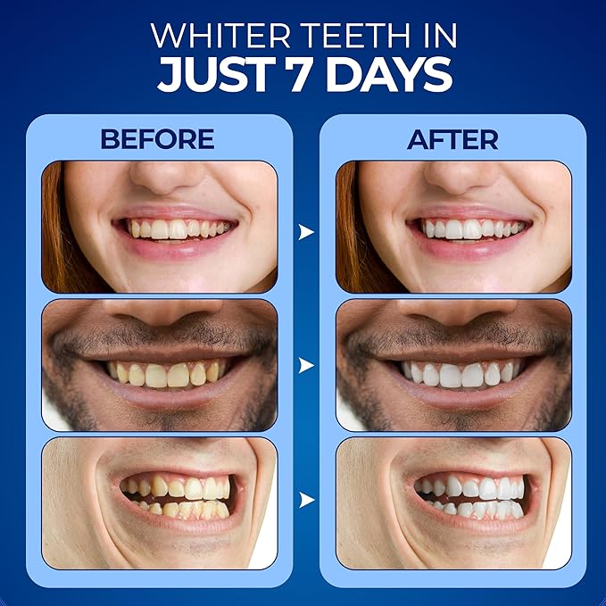 Premium Teeth Whitening Kit - LED Accelerator Light, 12% Hydrogen Peroxide Sensitivity Relief Gel Pen (Pack of 3), Red & Blue UV Whitening Spectrum, Sanitizing Travel Storage Case for Adults